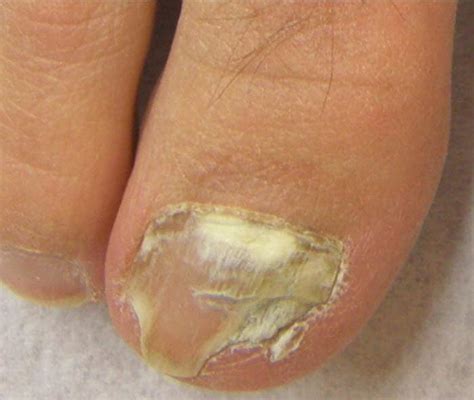 Effective Treatment of Onychomycosis