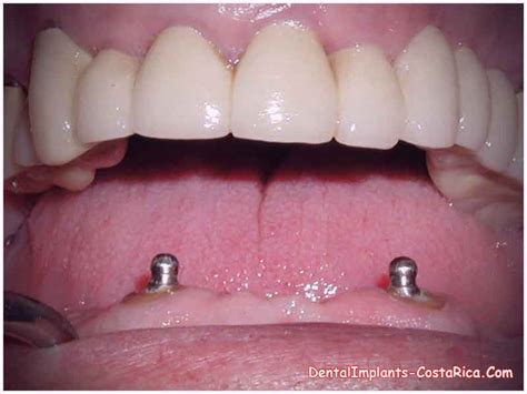 Snap on Dentures in Costa Rica - Dental Implants in Costa Rica