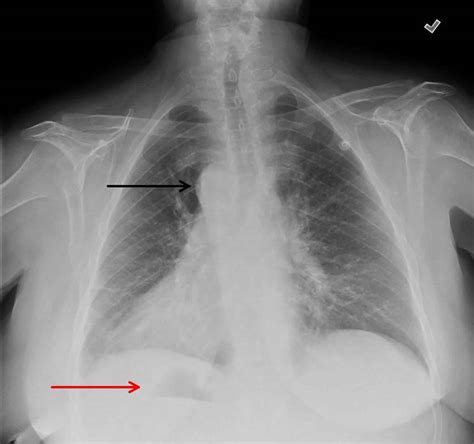 Situs inversus definition, causes, symptoms, diagnosis & treatment