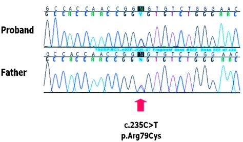 A Heparin Binding Site Arg79Cys Missense Mutation in the SERPINC1 Gene ...