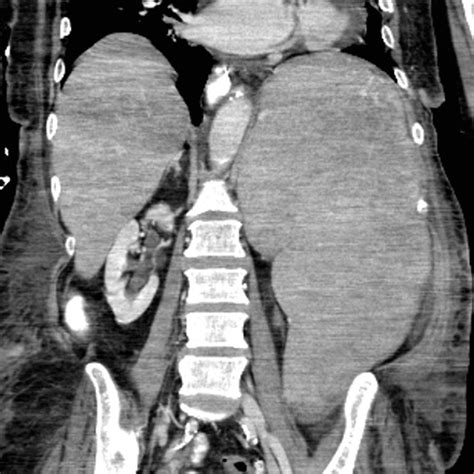 Spleen | Radiology Key