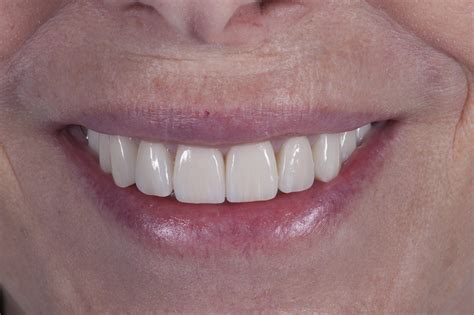 Crowns Vs. Porcelain Veneers Vs. Dental Implants and When to Use Which