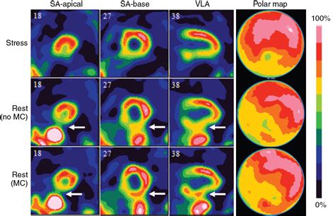 Single photon emission computed tomography | Radiology Key