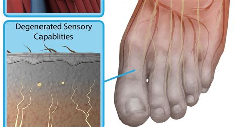 Diabetic neuropathy feet pictures | Symptoms and pictures