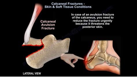 Skin & Soft Tissue Condition in Calcaneal Fractures ...