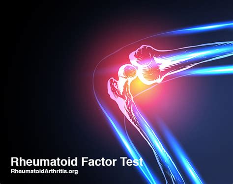 RF Test: What is the Normal Range for a Rheumatoid Factor Test? - RheumatoidArthritis.org