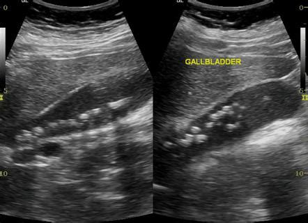 Gallbladder Stones Ultrasound