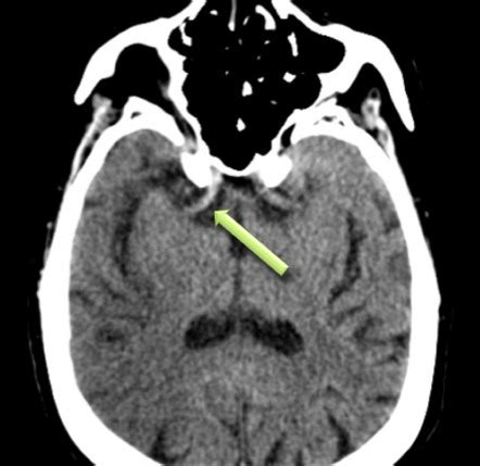 Hyperdense MCA sign | Radiology Case | Radiopaedia.org