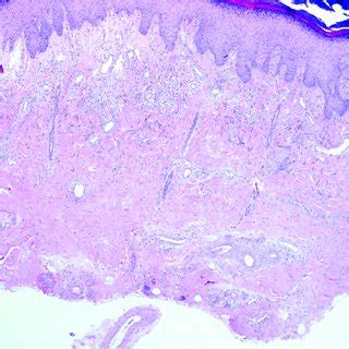 The dermis shows Early fibrosis and fibroblasts. | Download Scientific ...