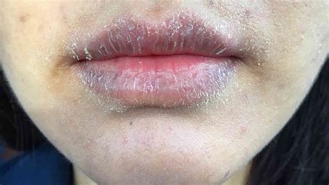 Lip Allergy: Cause, Symptoms, Treatment and Prevention of Lip Allergy