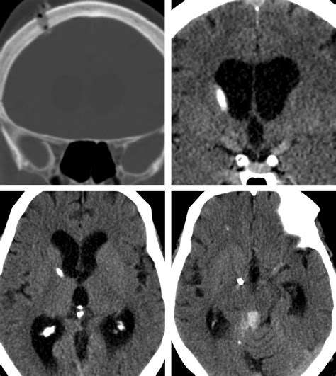 External Ventricular Drain | The Neurosurgical Atlas, by Aaron Cohen ...