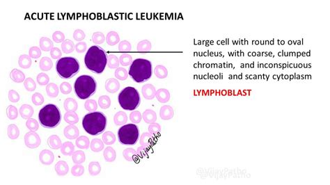 Peripheral smear findings in Leukemia - Illustrated - Pathology Made Simple