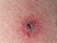 12 Best Tick bite symptoms ideas | tick bite, ticks, tick bite symptoms