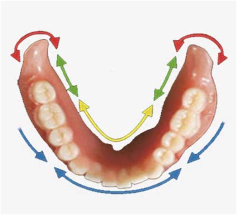 Lower Suction Dentures - SEMCD Suction Dentures | Pearl Denture Studio