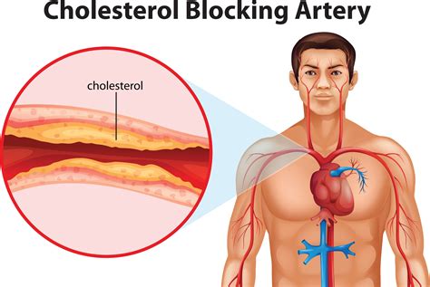 Cholesterol...The Good, the bad and . . . - BEAR LAKE MEMORIAL HOSPITAL