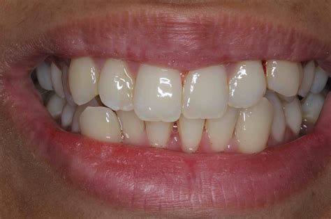 Porcelain Veneers or Braces? Make the Right Choice