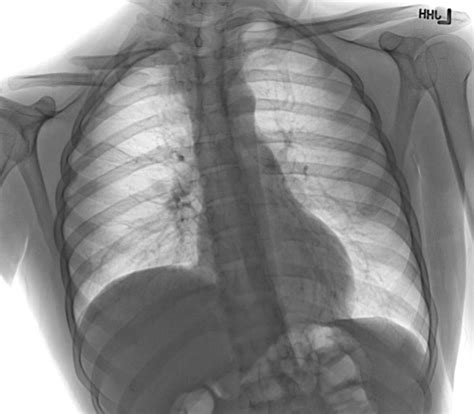 Phrenic Nerve Injury - StatPearls - NCBI Bookshelf