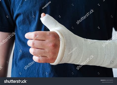 Man Plaster Cast On Broken Hand Stock Photo 1632742075 | Shutterstock