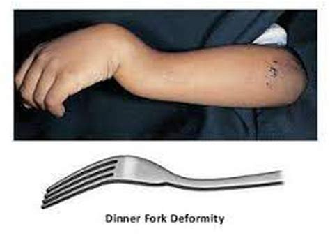 Dinner Fork Deformity - MEDizzy