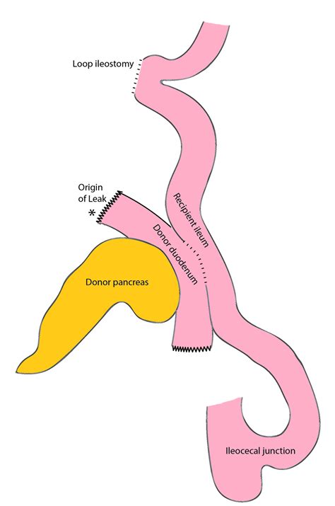 Cureus | Two-stage Enteric Exclusion to Salvage a Pancreas Transplant After an Early Post ...