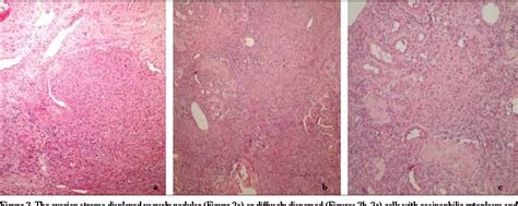 Figure 2 from Two patients with marginal symptoms showing hyperthecosis at the edge of ...