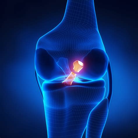 ACL Injury | Torn ACL | Knee Specialist | South Windsor, Enfield ...