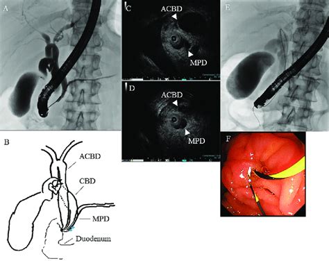 Endoscopic retrograde cholangiopancreatography (ERCP) and intraductal ...