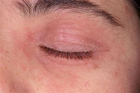 What Causes Itching Eyelids and How to Help? | MD-Health.com