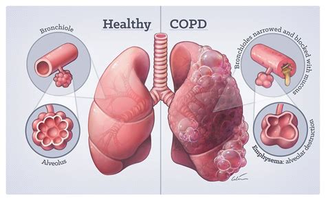 Copd Lungs Vs Normal Lungs Asthma Lung Disease | My XXX Hot Girl