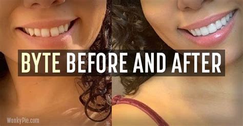 Byte Aligners: 21 Before & After Photos (Pics of Real Results!) || Check out these before and ...