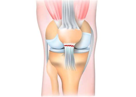 Patellar Tendon Repair Reconstruction| Knee Doctor | Sugar Land ...