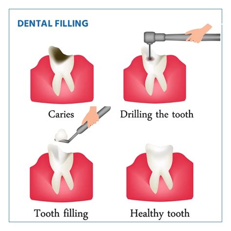 Best Dental Fillings Treatment For Oral Health