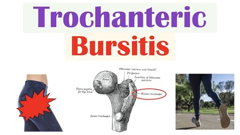 Trochanteric Bursitis - Causes, Symptoms, And Treatment Options