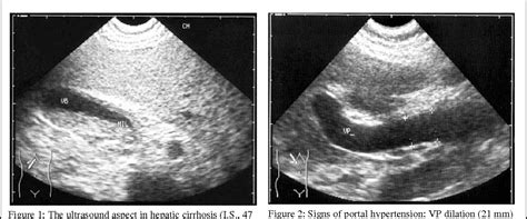 Figure 1 from LIVER CHIRRHOSIS - ULTRASOUND ASPECTS OF PORTAL ...