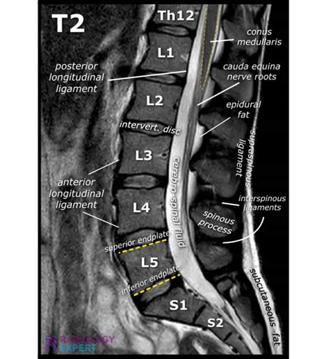 MRI Lumbar Spine