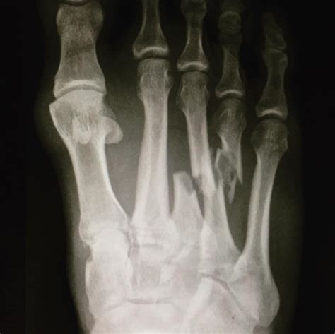 Kelly Slater Just FOLDED His Entire Foot Backwards & Broke 3 Bones In His Foot - SnowBrains