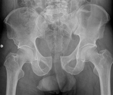 Pelvic Fracture X Ray