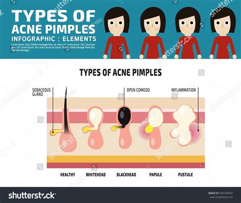 Types Anatomy Acne Pimples Infographic Elements Stok Vektör (Telifsiz ...