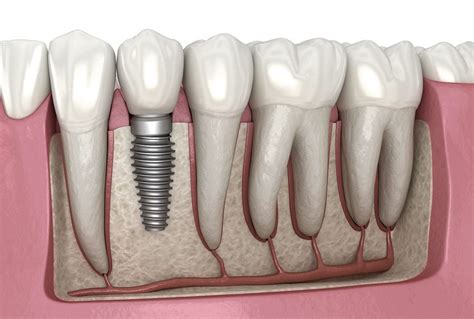 Dental Implant Recovery Process and Tips - All About Teeth