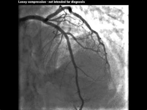 Coronary Angiogram - LAD - YouTube