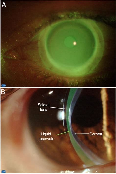 In vivo assessment of the anterior scleral contour assisted by ...