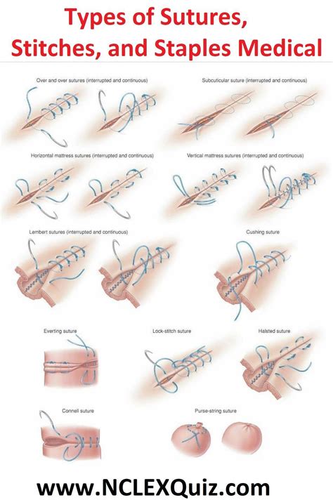 Types of Sutures, Stitches, and Staples Medical Wound Care Suturing ...