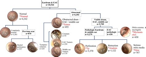 Tympanic Membrane Perforation Icd 9 Code