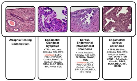 Endometrial Carcinoma Histology