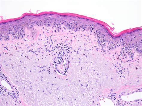 Lentigo Maligna Melanoma Histology