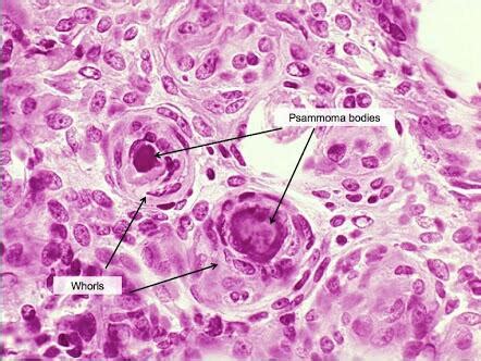 14. Dystrophic and metastatic calcification. Organ manifestations – greek.doctor