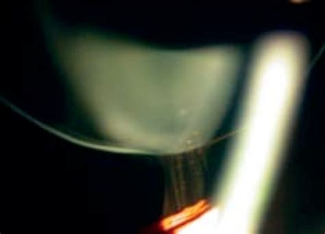 Slit-lamp photograph showing scanty, long zonules (right eye). Some ...