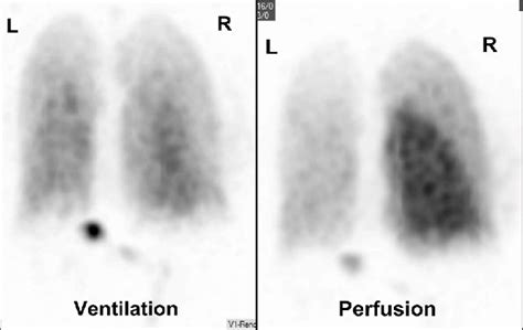 ventilation-perfusion scan – Liberal Dictionary