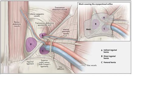 Types of Hernias | The Hernia Clinic