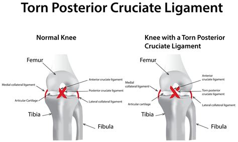 Posterior Cruciate Ligament (PCL) Injury - Symptoms - Treatment